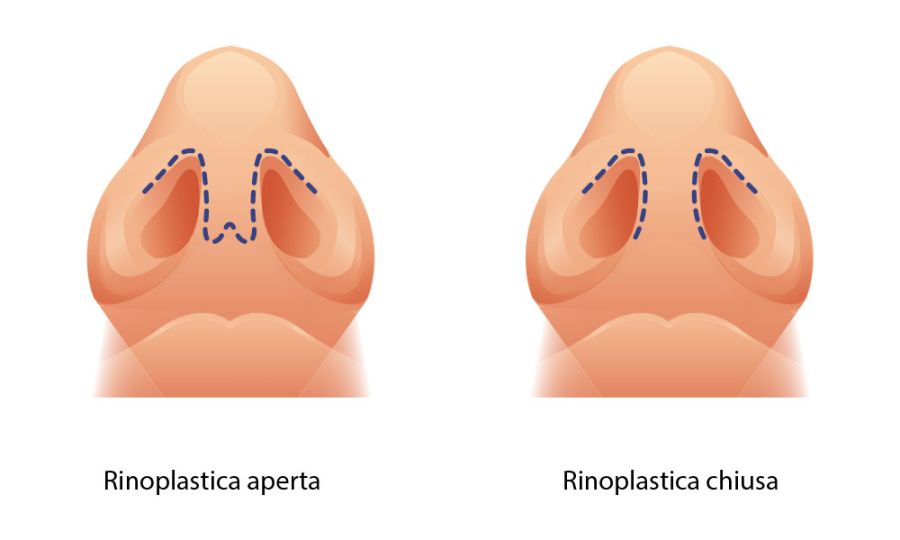 Rinoplastica aperta o rinoplastica chiusa